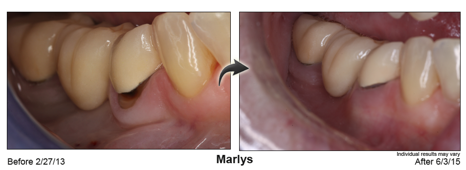 fix receding gums Raleigh