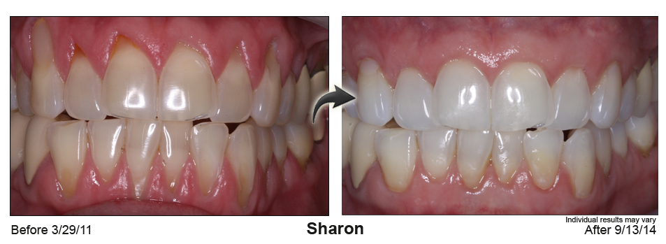 gum recession treatment Raleigh